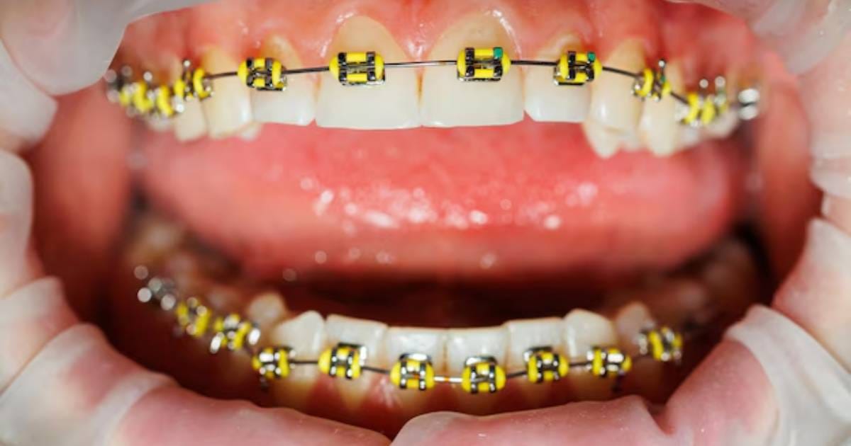 Yellow Braces: Cautionary Guide & Styling Tips